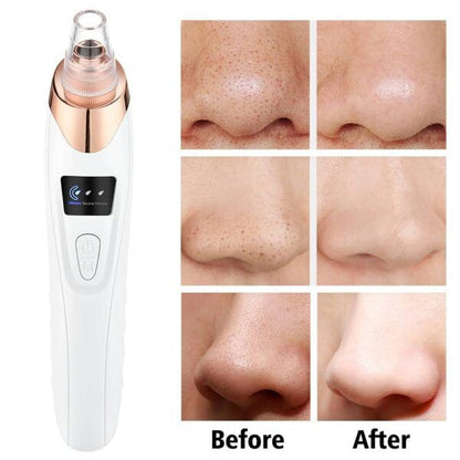 5-in-1 Blackhead remover | Rechargeable