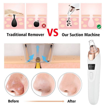 5-in-1 Blackhead remover | Rechargeable